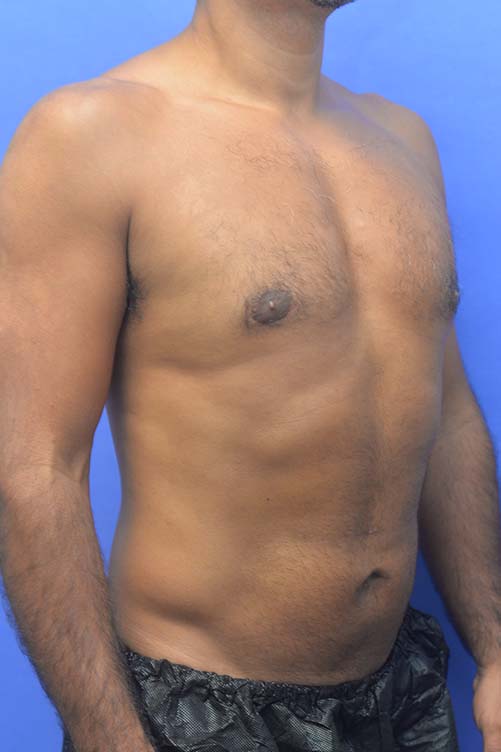 Liposuction Before and After | simply males