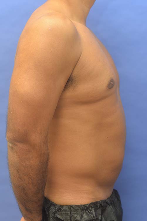 Liposuction Before and After | simply males