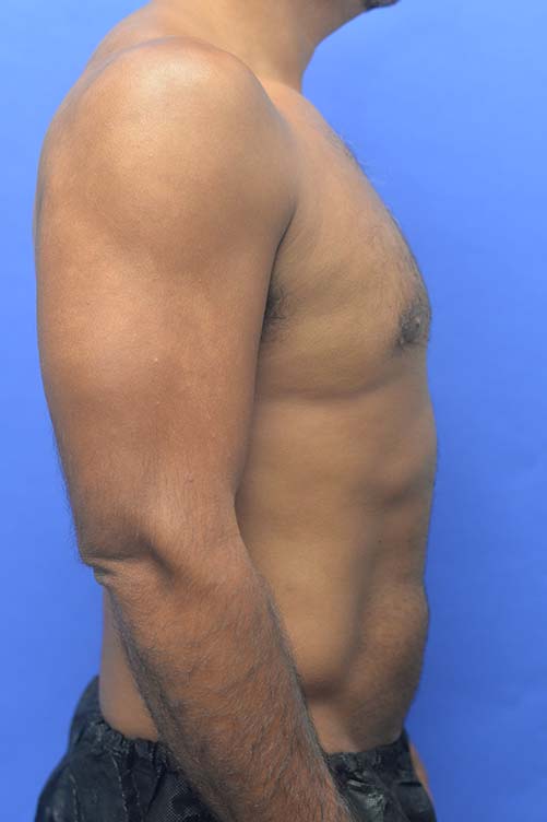 Liposuction Before and After | simply males