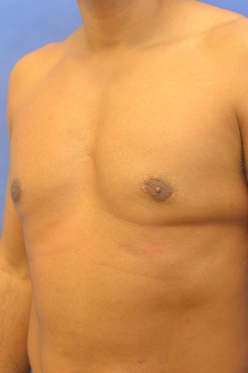 Liposuction Before and After | simply males