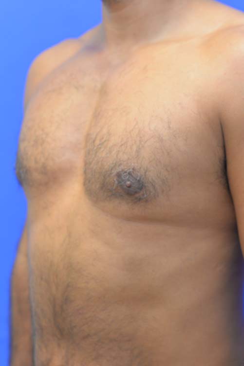 Liposuction Before and After | simply males