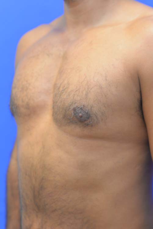 Liposuction Before and After | simply males