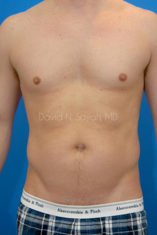 Liposuction Before and After | simply males