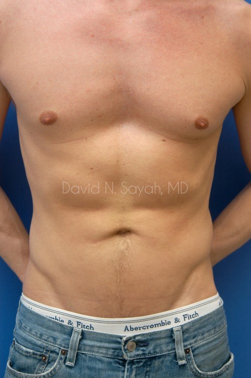 Liposuction Before and After | simply males