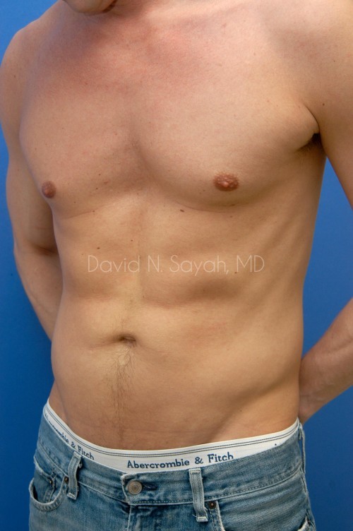 Liposuction Before and After | simply males