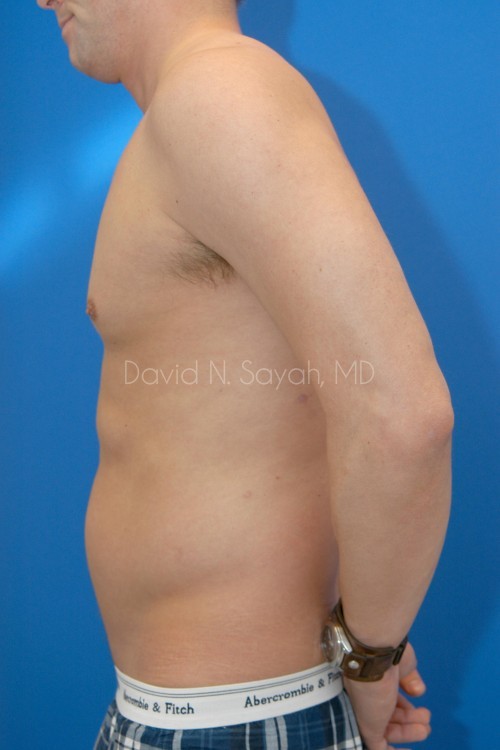 Liposuction Before and After | simply males