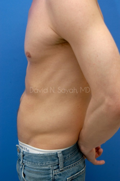 Liposuction Before and After | simply males