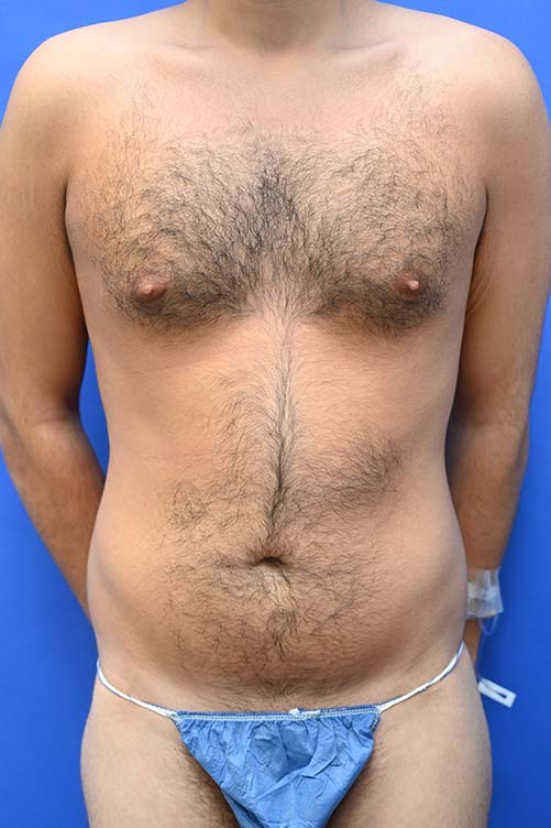Liposuction Before and After | simply males
