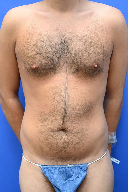 Liposuction Before and After | simply males