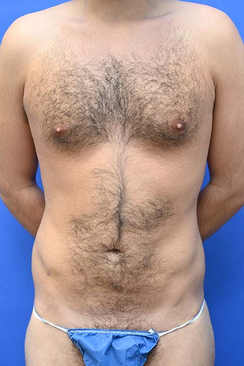 Liposuction Before and After | simply males