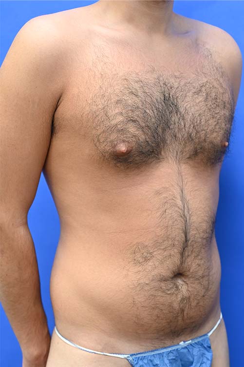 Liposuction Before and After | simply males