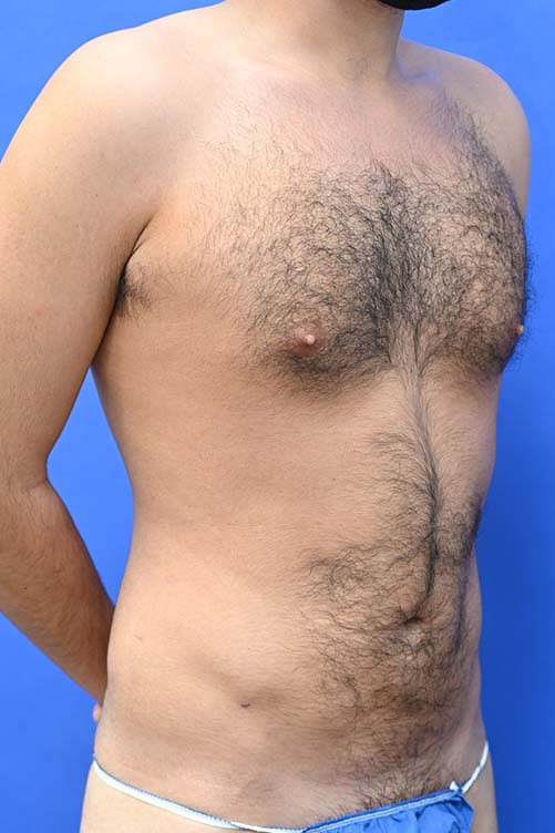 Liposuction Before and After | simply males