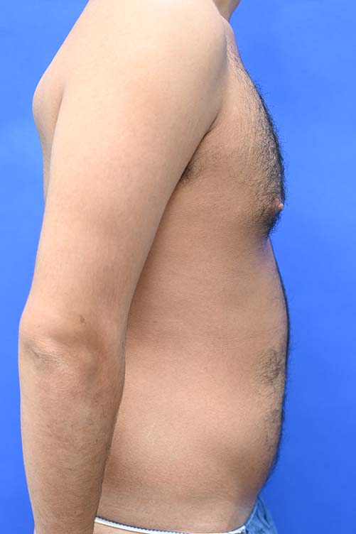 Liposuction Before and After | simply males