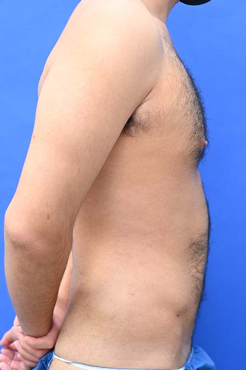 Liposuction Before and After | simply males