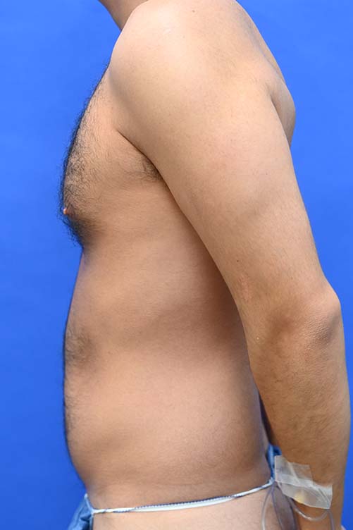 Liposuction Before and After | simply males