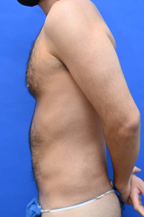 Liposuction Before and After | simply males