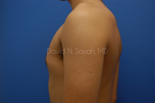Liposuction Before and After | simply males