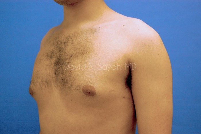 Liposuction Before and After | simply males