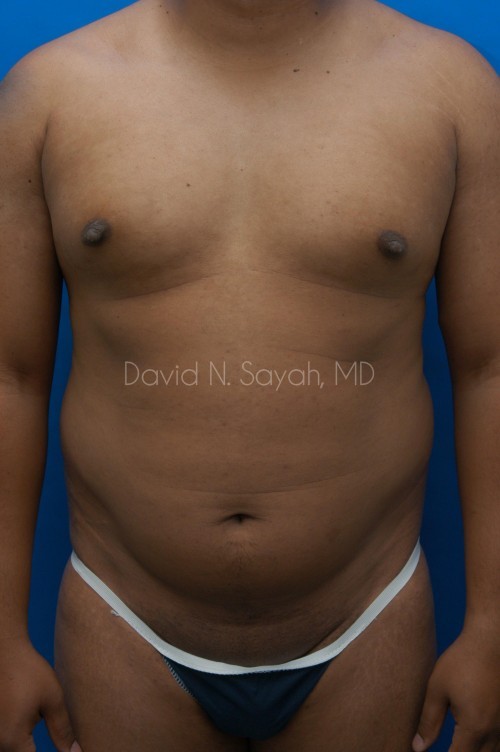 Liposuction Before and After | simply males