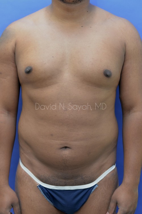 Liposuction Before and After | simply males