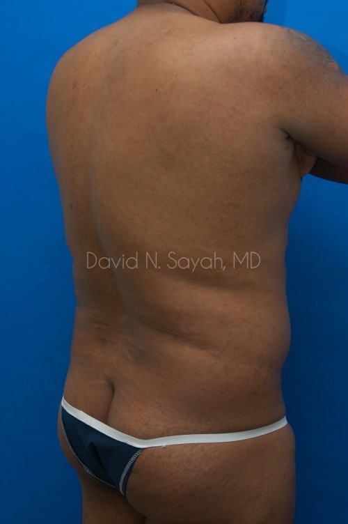 Liposuction Before and After | simply males