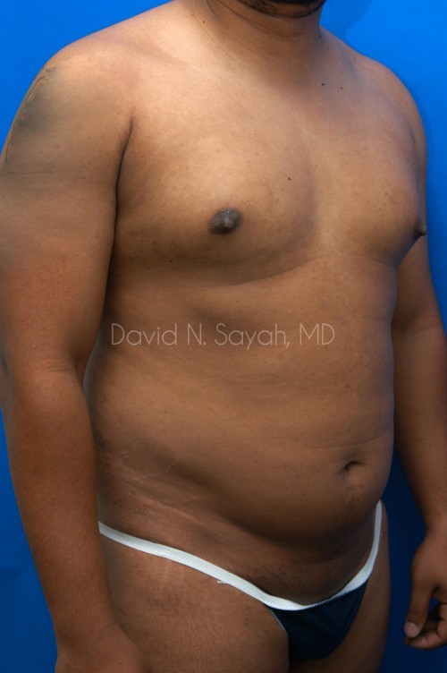 Liposuction Before and After | simply males