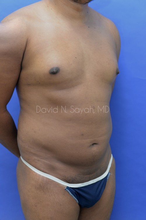 Liposuction Before and After | simply males