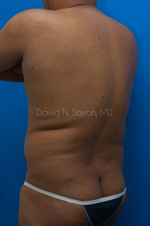 Liposuction Before and After | simply males