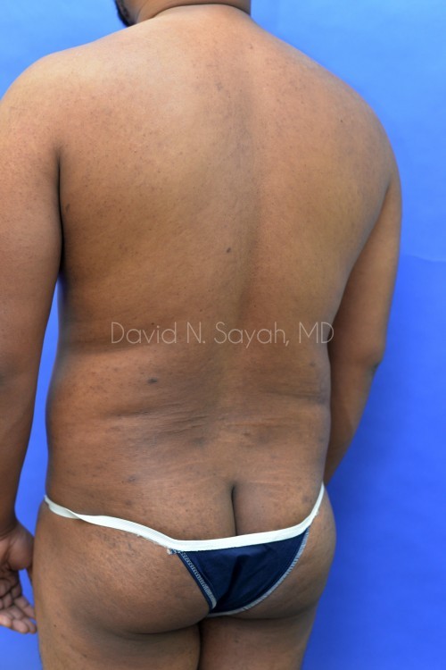 Liposuction Before and After | simply males