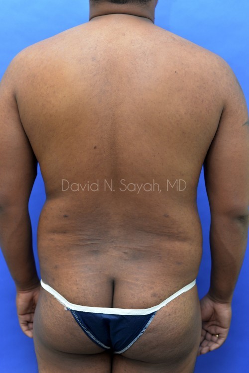 Liposuction Before and After | simply males