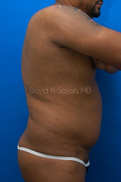 Liposuction Before and After | simply males