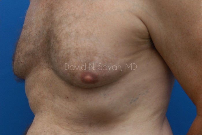 Liposuction Before and After | simply males