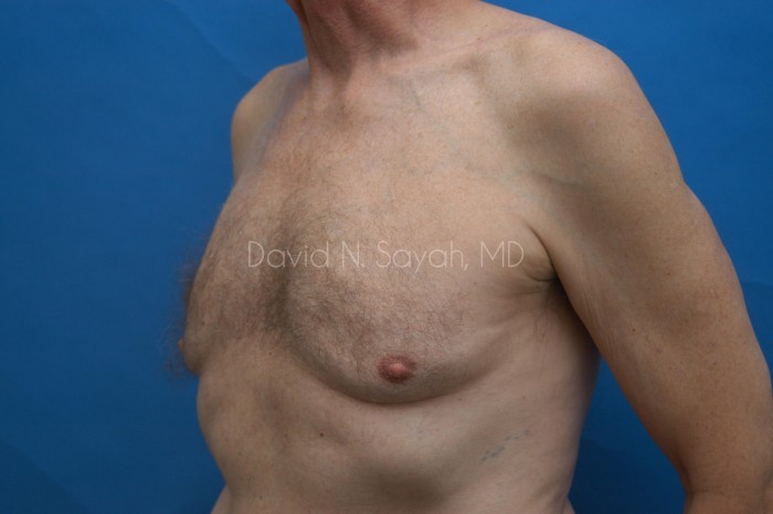 Liposuction Before and After | simply males