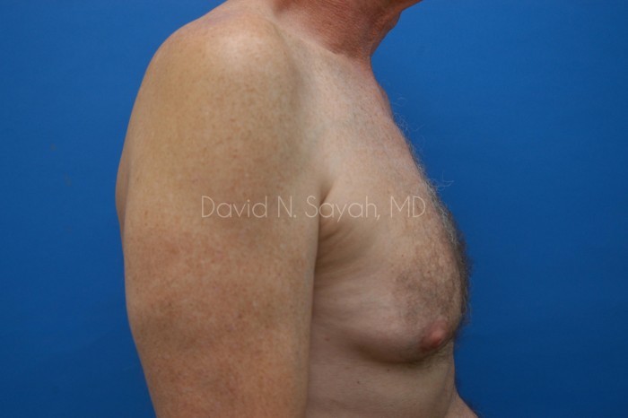 Liposuction Before and After | simply males