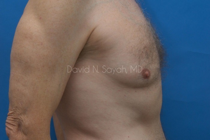 Liposuction Before and After | simply males