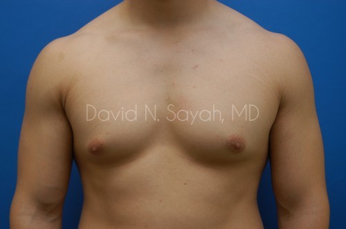 Liposuction Before and After | simply males