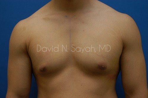 Liposuction Before and After | simply males