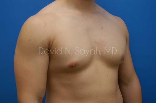 Liposuction Before and After | simply males