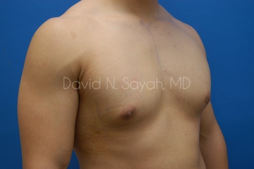 Liposuction Before and After | simply males