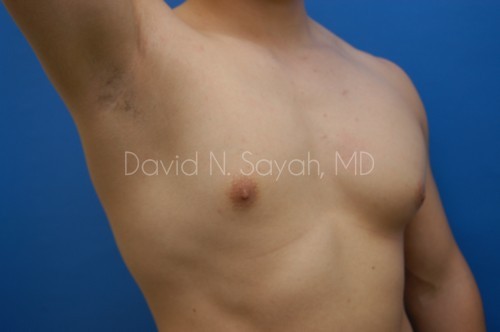 Liposuction Before and After | simply males