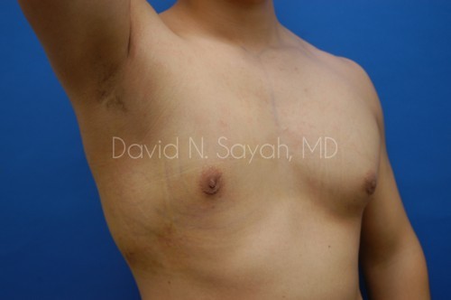 Liposuction Before and After | simply males