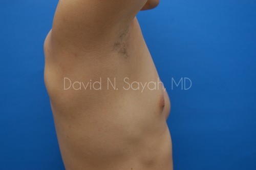 Liposuction Before and After | simply males