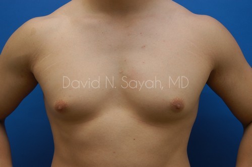 Liposuction Before and After | simply males