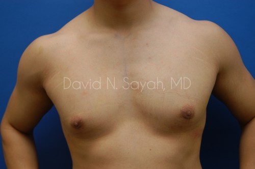 Liposuction Before and After | simply males