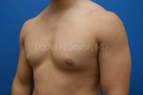 Liposuction Before and After | simply males