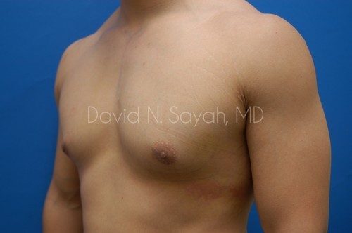 Liposuction Before and After | simply males