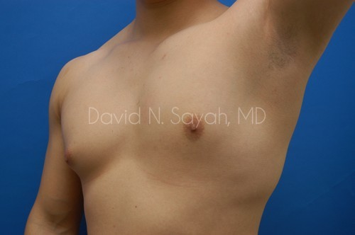 Liposuction Before and After | simply males