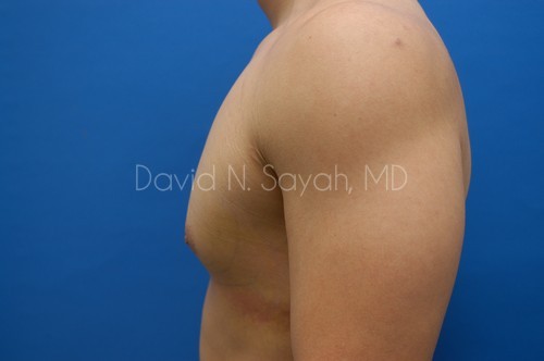 Liposuction Before and After | simply males