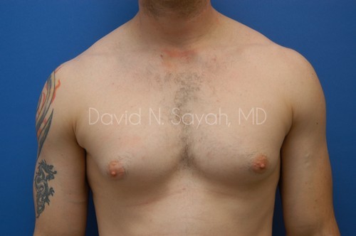 Liposuction Before and After | simply males