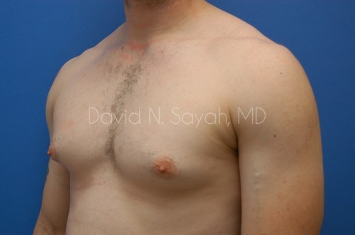 Liposuction Before and After | simply males